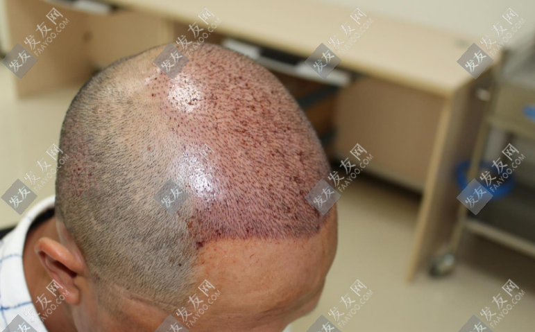 威海植發醫院排名哪家好？熱門植發醫院推薦！